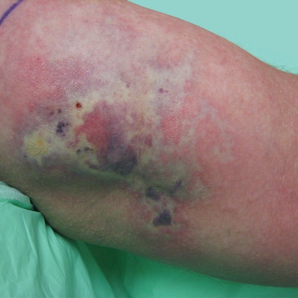 Insect Bites And Stings Dermboard