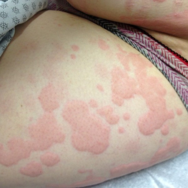 images of hives