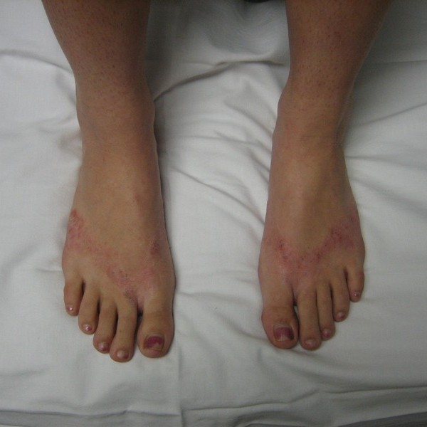 Allergic contact dermatitis to flip-flops