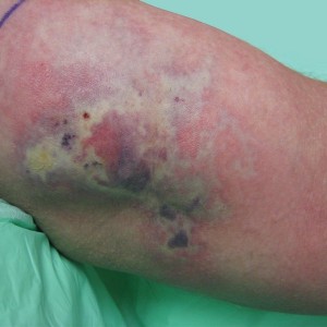 A person with bruises on their leg.