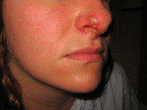 A woman with a large, red, bulbous, inflamed nose.