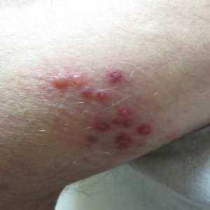 A close up of some red spots on the arm