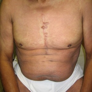 A man with scars on his chest and abdomen.