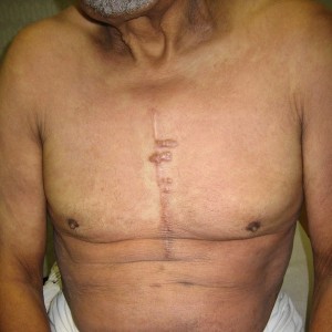 A man with scars on his chest and torso.