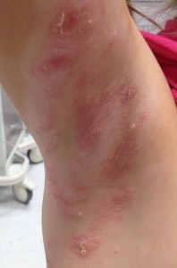 A person with red and white spots on their legs.