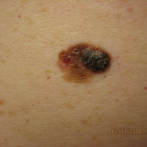 A close up of the skin on a person 's chest