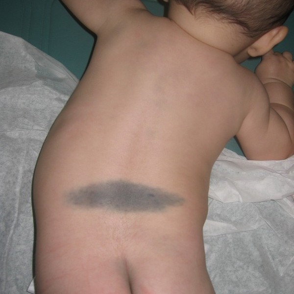 Mongolian spot- birthmark