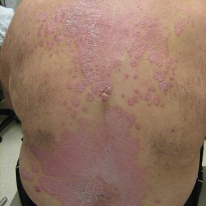 A man with psoriasis on his back and chest.