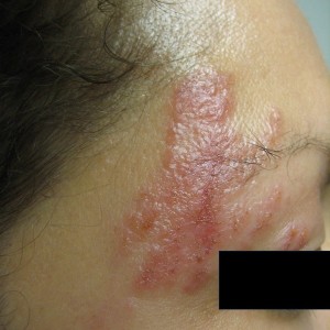 A person with a large rash on their face.