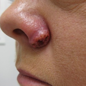 A person with a black patch on their nose.