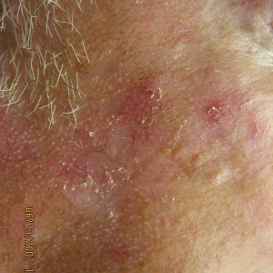 Several actinic keratoses on the right cheek