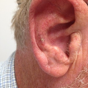 A man 's ear with the most visible area of an ear.
