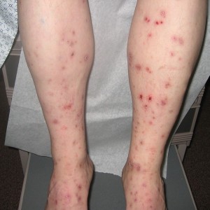 A person with red spots on their legs.