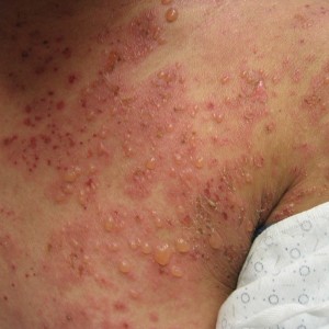 A person with red and white spots on their back.