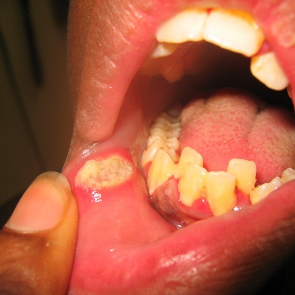 Aphthous Ulcerations (Canker Sores)