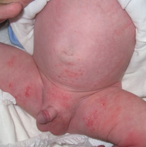 This baby developed pus-filled blisters caused by Staphylococcus aureus