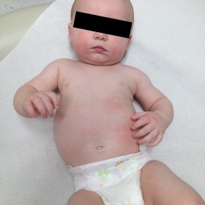 A baby with eczema on cheeks and belly.