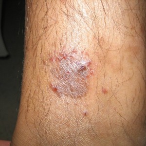 A close up of the skin on a person 's leg