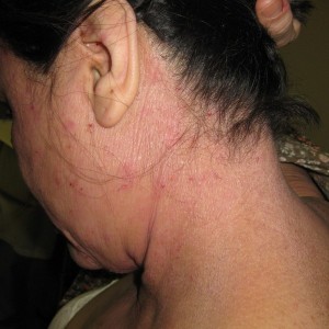 A woman with red marks on her neck and back.