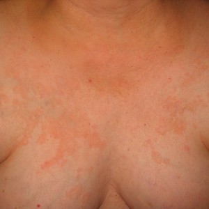 A woman with red spots on her chest.