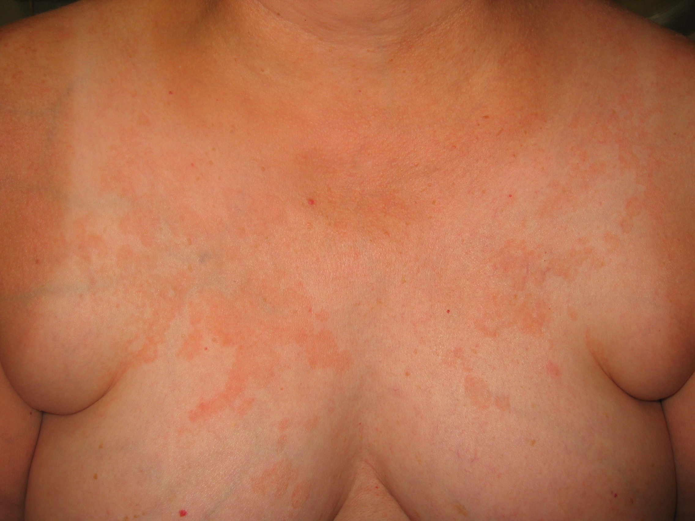 дерматит под грудями фото фото 72