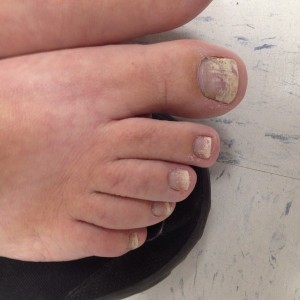 A person with toenail fungus on their feet.