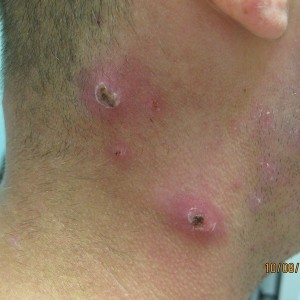 A man with an infection on his neck.