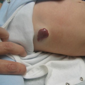 A person with an unopened wound on their chest.