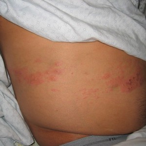 A person with red bumps on their back.