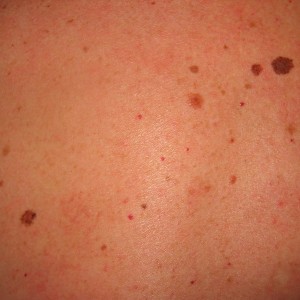A close up of the skin on a person 's face