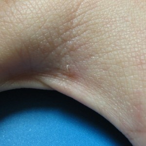 A person 's hand with a wart on it.