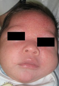 A baby with seborrheic dermatitis
