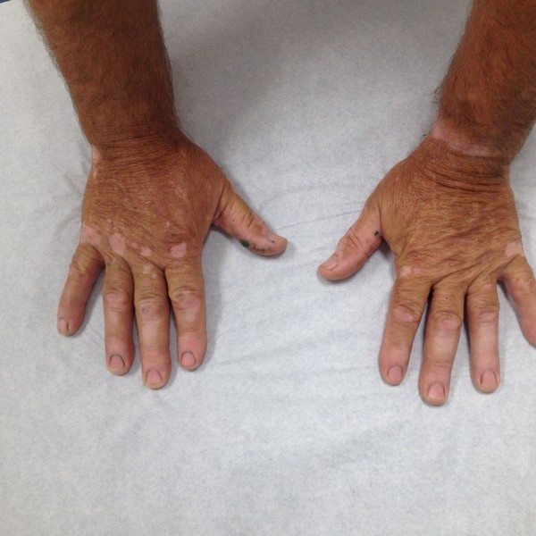 vitiligo (2)