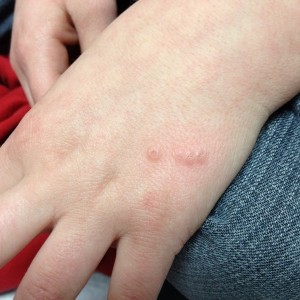 A person 's hand with red spots on it.