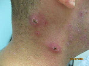 Boils (furuncles) caused by methicillin-resistant Staphylococcus aureus (MRSA) or commonly known as "Superbug"
