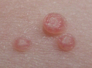 A close up of three small pink dots on the skin
