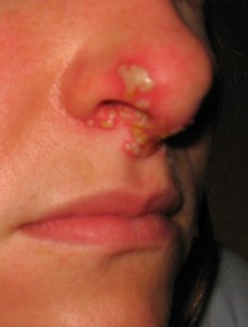 "Cold sore" or herpes simplex on nose