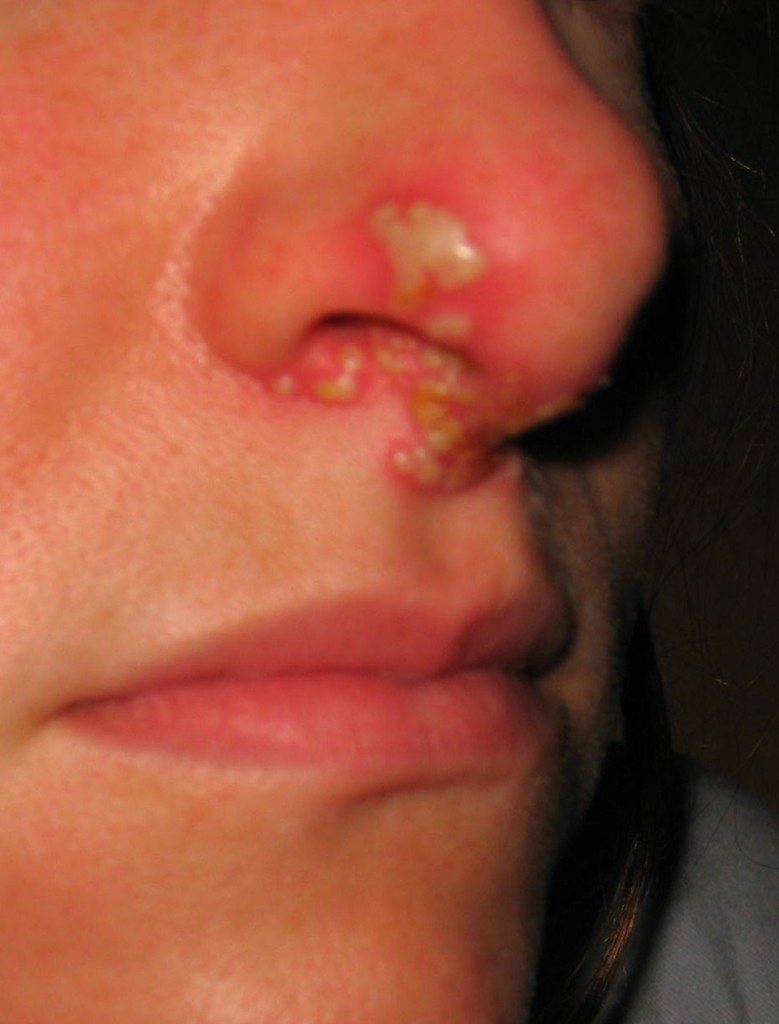 HSV herpes simplex on nose