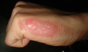A person with psoriasis on their hand.