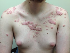 A man with psoriasis on his chest and shoulders.