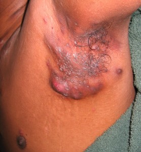 A person with a large tumor on their chest.