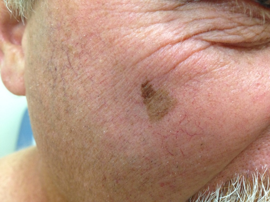 melanoma in situ on cheek
