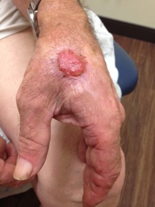 A person with a large wart on their hand.