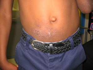 Allergic contact dermatitis to nickle in the belt buckle